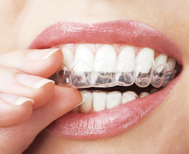 Comment faire pour blanchir les dents